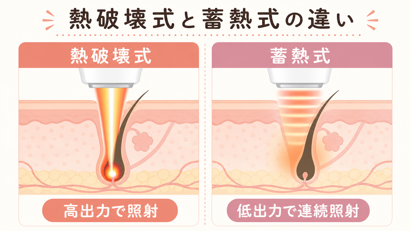医療脱毛の熱破壊式と蓄熱式の照射方法を比較する図解