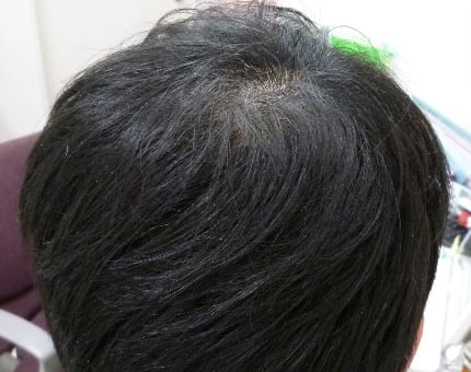 治療後